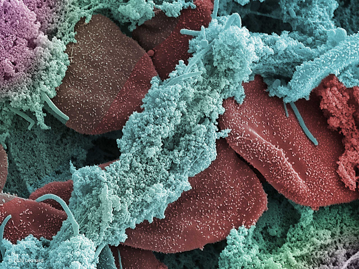 COVID-19 infected Red Blood Cell