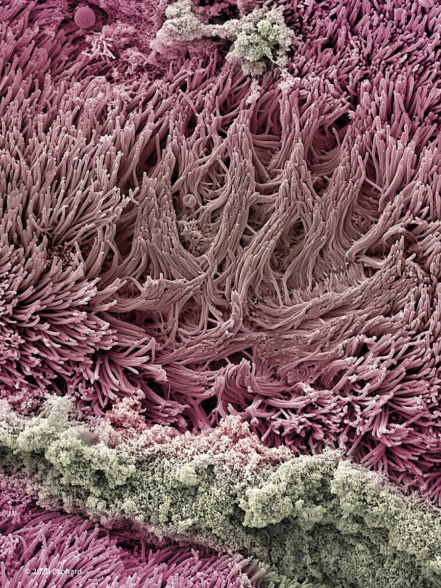 COVID-19 Infected Nasal Epithelial Tissue