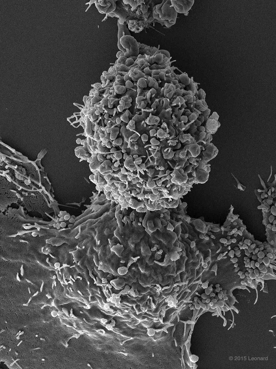 Breast Cancer Cells (BT549 Triple Negative)