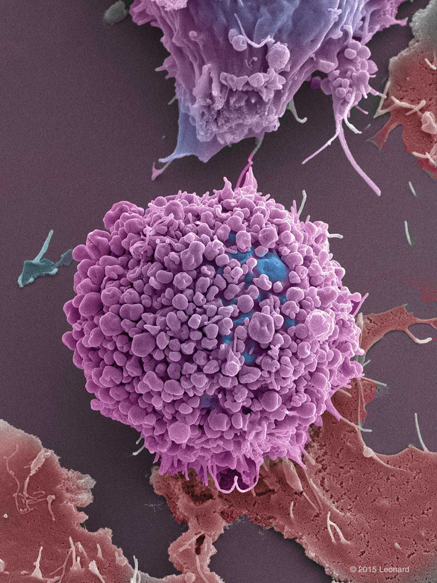Breast Cancer Cells (BT549 Triple Negative)