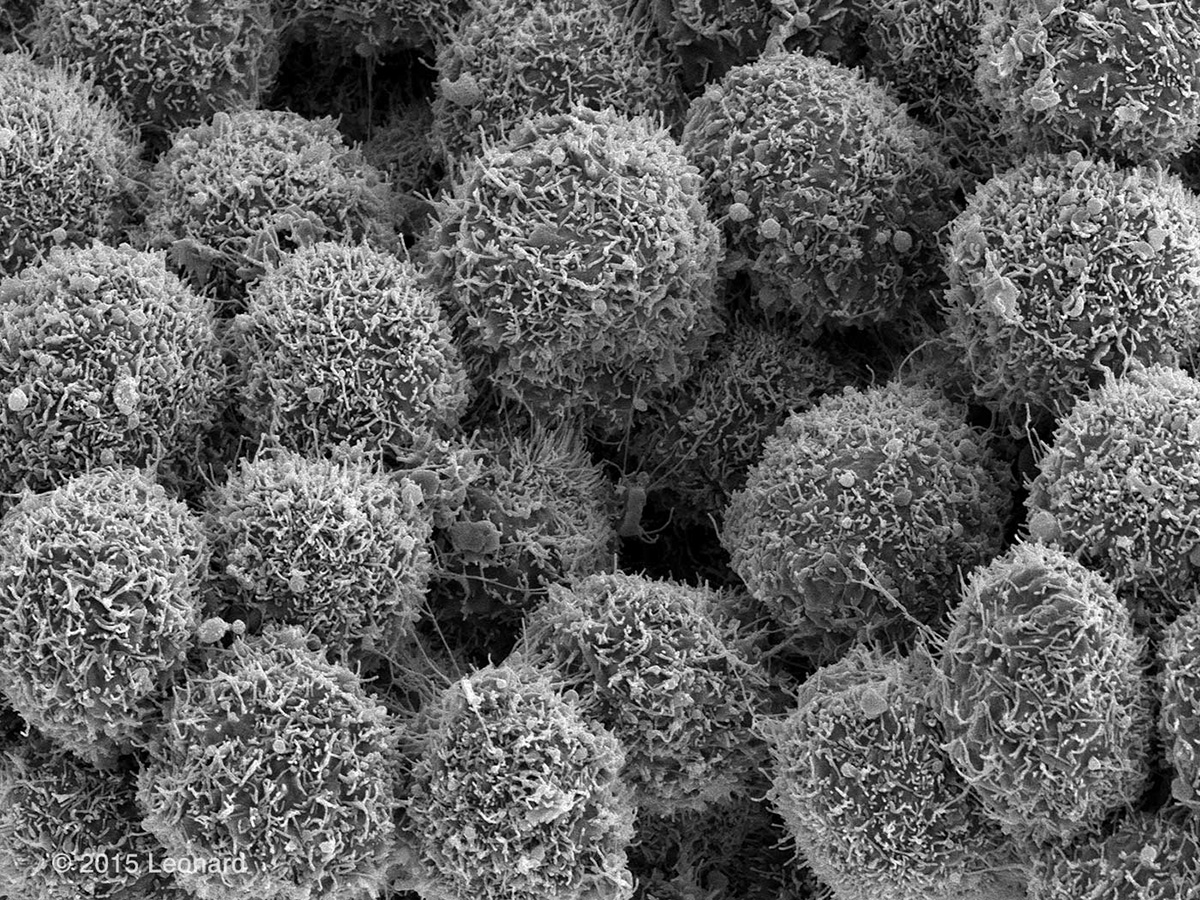 Breast Cancer Cells (HER-2 Positive)