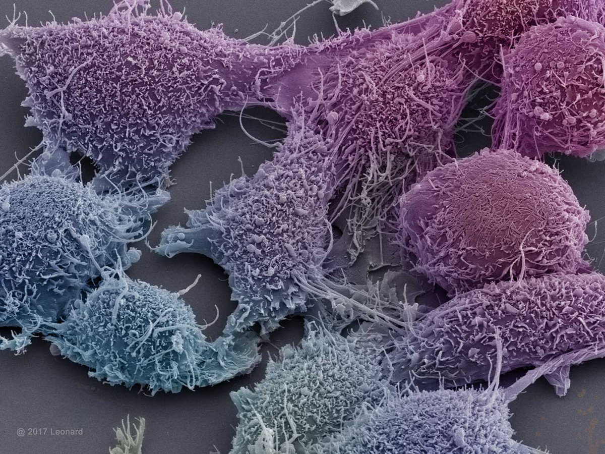 Prostate Cancer Cells