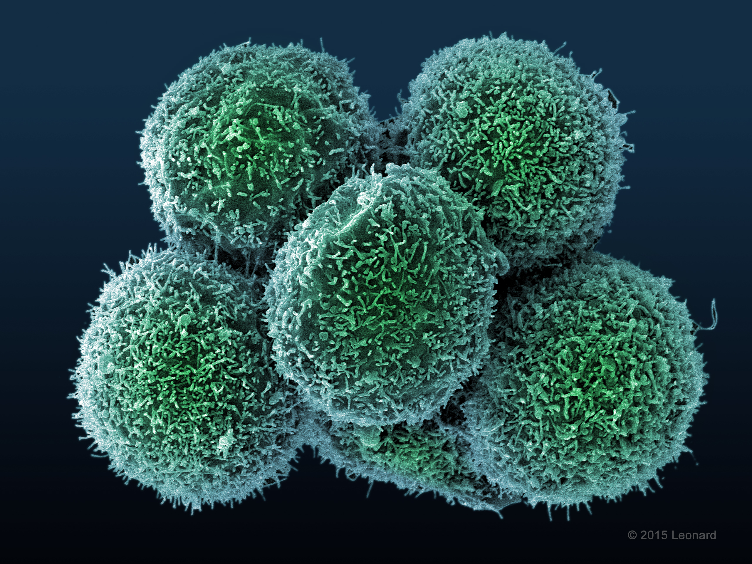 Cluster of at least six HER2 breast cancer cells. They look like Dunkin' munchkins.