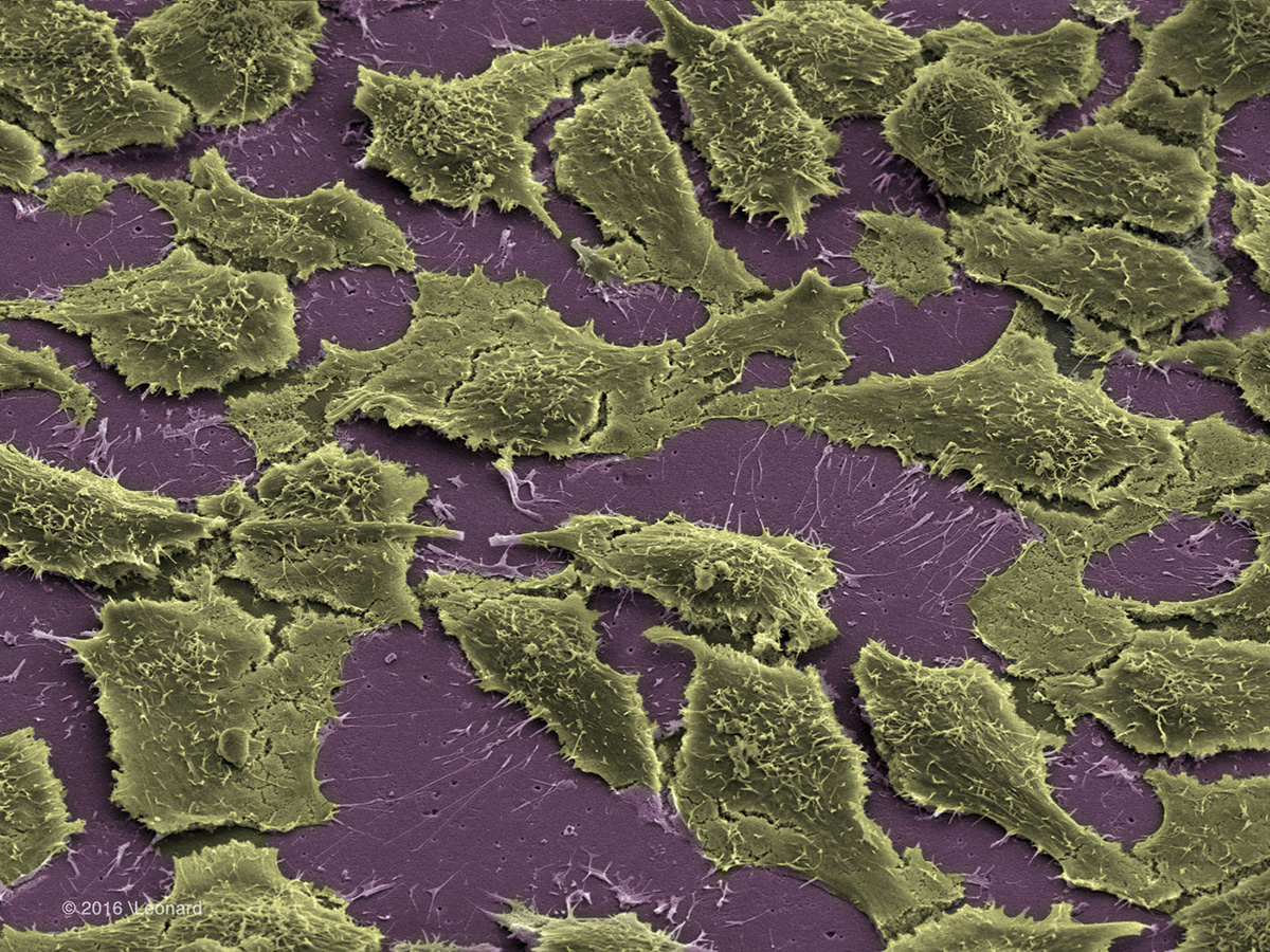 Cervical Cancer Cells