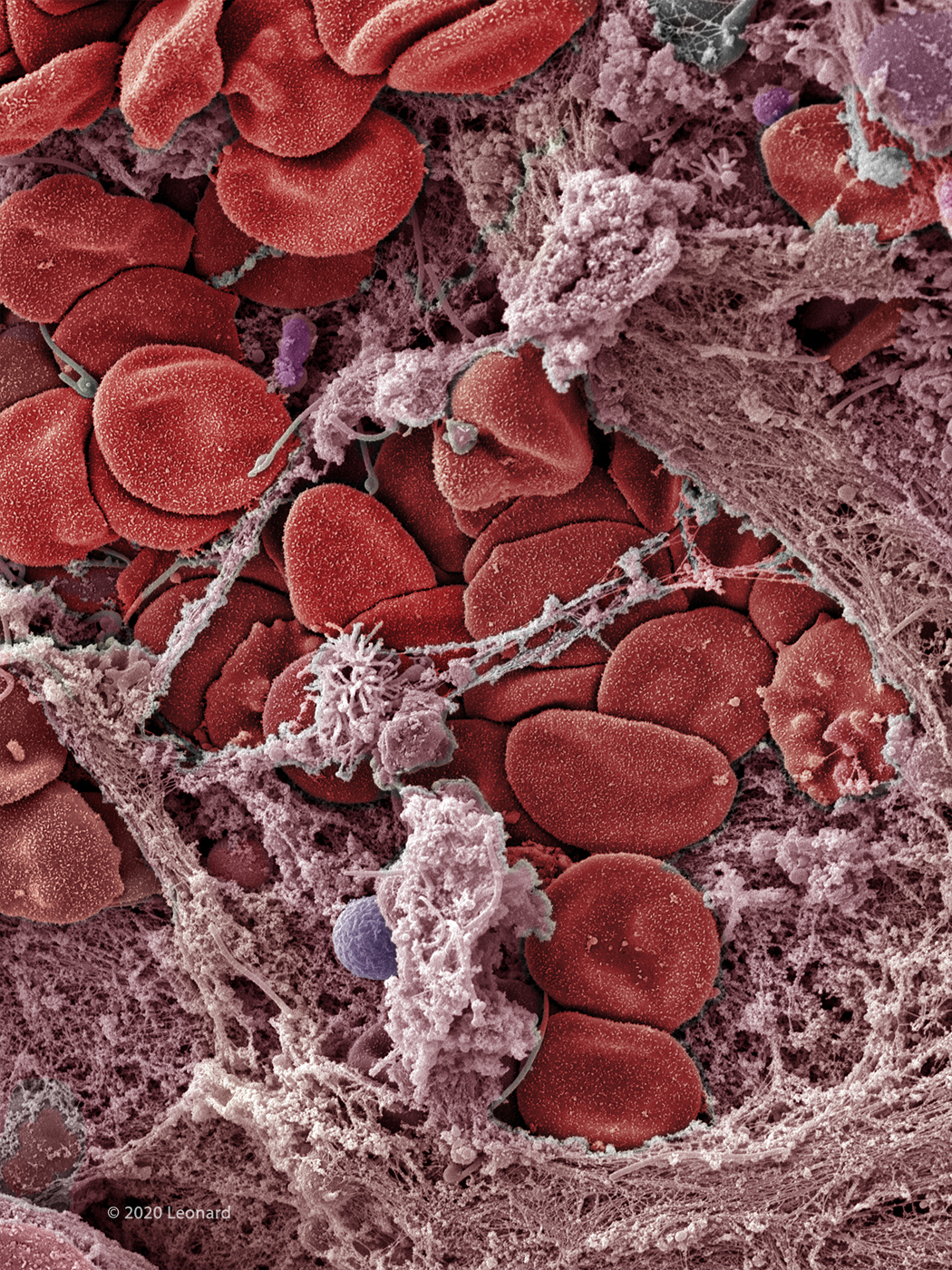 COVID-19 damaging nasal epithialial tisse