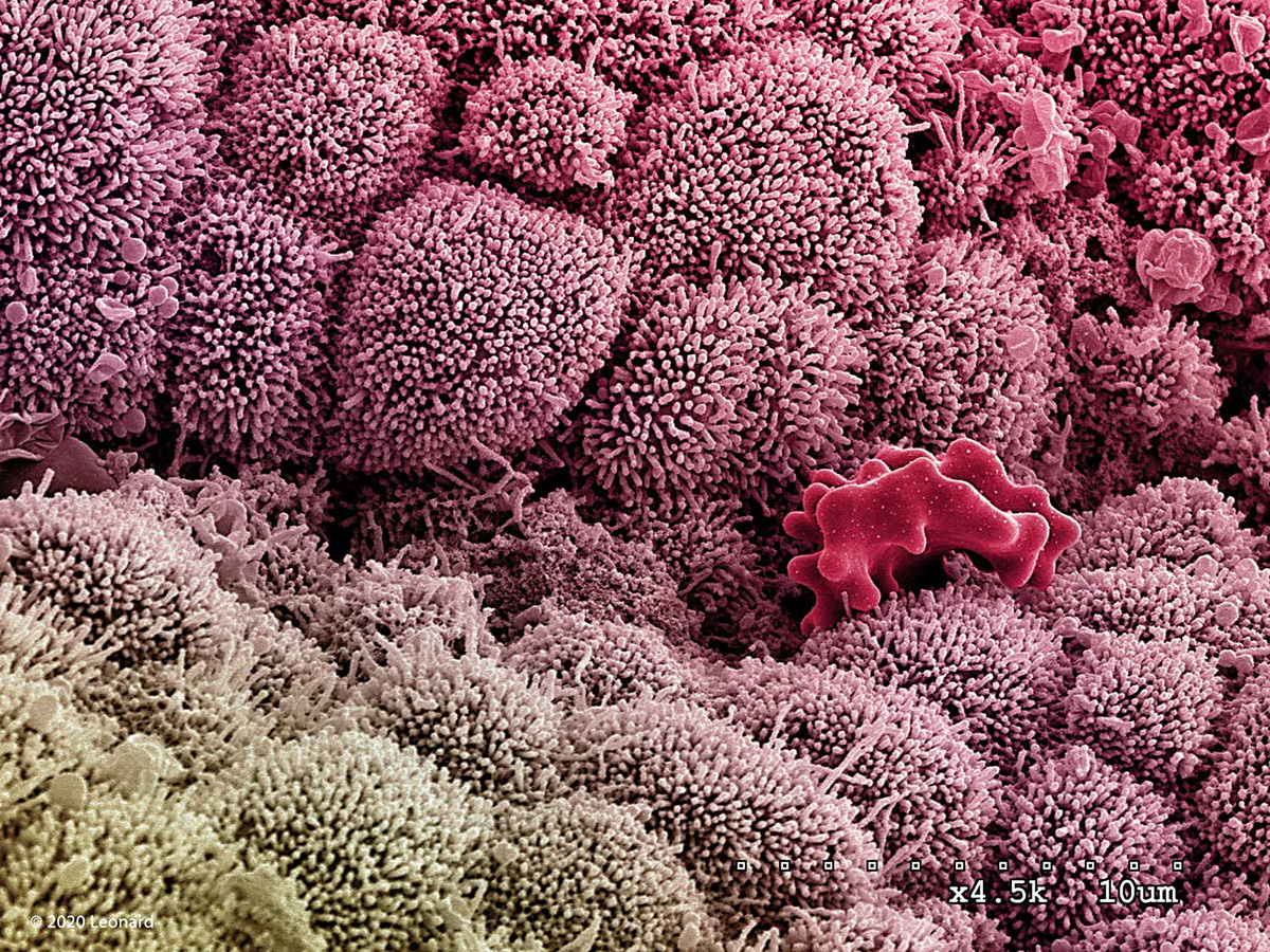 COVID Infected Nasal Epithelial Tissue