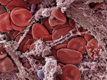 COVID-19 damaging nasal epithialial tisse