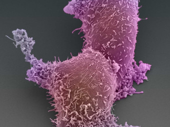 Prostate Cancer Cells (trying to hitch a ride)