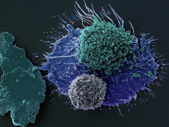Breast Cancer Cells (BT549 Triple Negative)