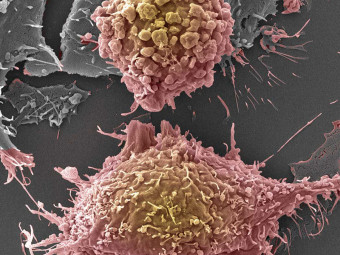Breast Cancer Cells (BT549 Triple Negative)